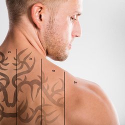 East Coast Laser Tattoo Removal