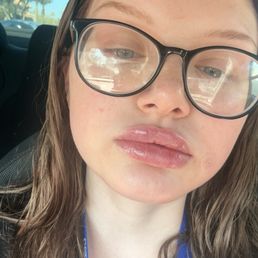 Right after lip filler appointment Right after lip filler appointment