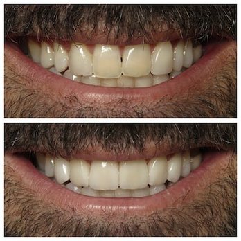 White Pine Dental - Before & After Results at White Pine Dental | Herriman, UT - Cosmetic Dentists Near Me - Murray, Utah White Pine Dental - Before & After Results at White Pine Dental | Herriman, UT - Cosmetic Dentists Near Me - Murray, Utah