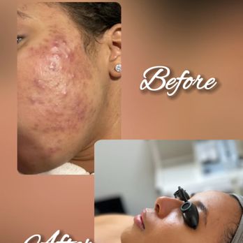 Skincera Beauty - Acne Improvement of Monthly Facials. - Skin Care Near Me - Westfield, New Jersey Skincera Beauty - Acne Improvement of Monthly Facials. - Skin Care Near Me - Westfield, New Jersey