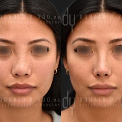 Donald B Yoo, MD, FACS - Primary Asian Rhinoplasty with Rib cartilage and DCF