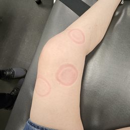 After the cupping.  Some ppl will get bruises that are this big. Mine didn't bruise.  Just red.