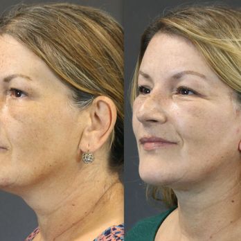 FaceLove - Deep Plane Face Lift - Cosmetic Surgeons Near Me - Oakbrook Terrace, Illinois FaceLove - Deep Plane Face Lift - Cosmetic Surgeons Near Me - Oakbrook Terrace, Illinois