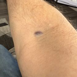 Quest Diagnostics - So many perfect draws and then this
