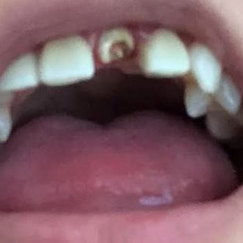 Beverly Hills Dentistry - Warning - graphic pic
Tooth broke off + inflamed gum - General Dentistry Near Me - Beverly Hills, California Beverly Hills Dentistry - Warning - graphic pic
Tooth broke off + inflamed gum - General Dentistry Near Me - Beverly Hills, California