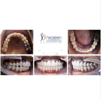 Nikaeen Orthodontics - After - Orthodontists Near Me - Los Angeles, California