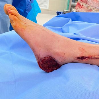 Andrew I Levy, DPM - Preoperative ulcer - Podiatrists Near Me