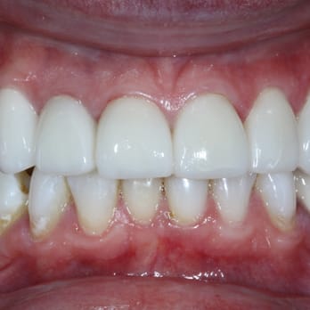Mitra E Simanian, DDS - After - Cosmetic Dentists Near Me - Beverly Hills, California