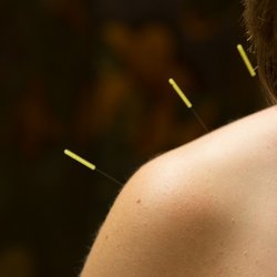 Integrative Acupuncture - Acupuncture for pain management