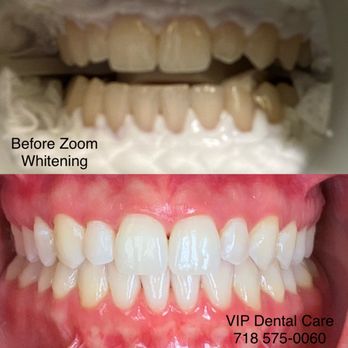 VIP Dental Care - Zoom Teeth Whitening @vipdentalcare - General Dentistry Near Me - Forest Hills, New York VIP Dental Care - Zoom Teeth Whitening @vipdentalcare - General Dentistry Near Me - Forest Hills, New York