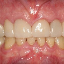 Williamson Dental - Williamson Dental | Dental Crowns