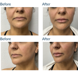 Laser Esthetica - Dermal Fillers: Before & After