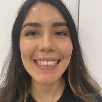 FriendLee Orthodontics - Congratulations to our beautiful Nadia, all done with Invisalign - Orthodontists Near Me - Anaheim, California