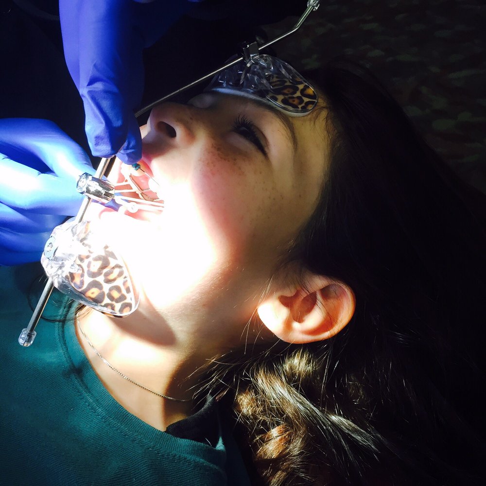 Premier Orthodontics - Getting fitted for this new device! Time to pull the top jaw forward! - Orthodontists Near Me - Oxnard, California Premier Orthodontics - Getting fitted for this new device! Time to pull the top jaw forward! - Orthodontists Near Me - Oxnard, California
