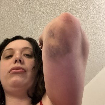 Denver Police Headquarters - Bruises - Police Departments Near Me - Denver, Colorado