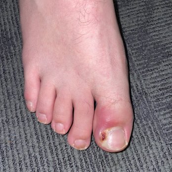 Luxury Nails & Spa - INFECTED TOE!!!!!! - Nail Salons Near Me - Naples, Florida