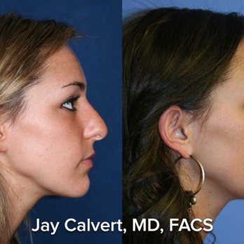 Dr Jay Calvert Plastic Surgery - Rhinoplasty by Dr Jay Calvert - Cosmetic Surgeons Near Me - Newport Beach, California Dr Jay Calvert Plastic Surgery - Rhinoplasty by Dr Jay Calvert - Cosmetic Surgeons Near Me - Newport Beach, California