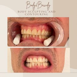 Teeth Whitening