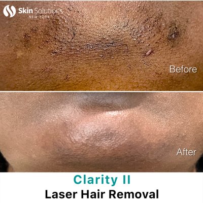 Clarity II Facial Laser Hair Removal (FDA Approved ) - Clarity II Laser hair removal works by emitting bursts of concentrated light, which we call laser. Pigments in the hair absorb the light, which converts into heat and energy, which damages the hair and hair follicles that produce hair. Hair follicles are damaged when high heat is applied to that area. Temperature above 140°F (60°C) damages the target cell by breaking down the protein and collagen in the cell, which ultimately inhibits hair follicles from producing hair. Because the pigment in the hair causes the laser to be absorbed into the hair and hair follicle, laser hair removal is effective in inhibiting hair growth while minimizing skin damage.