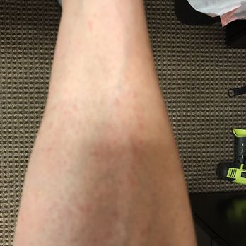Smooth Laser - Laser Hair Removal Near Me - Keller, Texas Smooth Laser - Laser Hair Removal Near Me - Keller, Texas