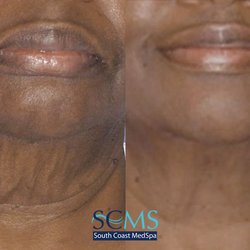 South Coast MedSpa - Morpheus8 Neck Treatment