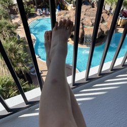 Tang Dynasty Foot Spa - Bruised legs after the foot massages last night