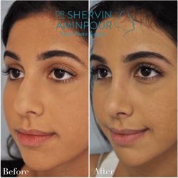 Shervin Aminpour, MD - We all want plastic surgery but we don't want anyone to know that we had plastic surgery done. Dr. Aminpour focuses on the details.