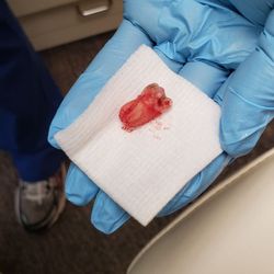 Irwin Jerome Wedner, DDS - My Wisdom tooth on gauze.