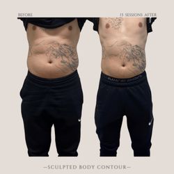 Sculpted Body Contour - Using Ultrasonic Cavitation to blast fat cells using sound waves to erupt and liquefy the adipose tissue.