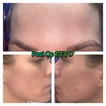 SkinSpaMED Dallas - 5 days after and I'm still not completely healed! The bottom right pic shows a blemish I picked at while healing. BIG NO NO! - Skin Care Near Me - Dallas, Texas SkinSpaMED Dallas - 5 days after and I'm still not completely healed! The bottom right pic shows a blemish I picked at while healing. BIG NO NO! - Skin Care Near Me - Dallas, Texas