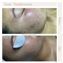 Lumiere Skin - Acne clear