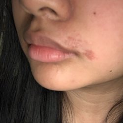 Mehndi Beauty Salon - Burn status following morning