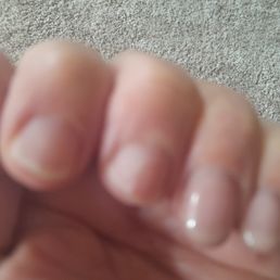 2 first nails completely gone 2 first nails completely gone