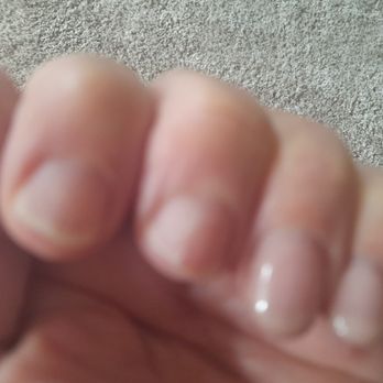 Sunny Days - 2 first nails completely gone - Nail Salons Near Me - Mundelein, Illinois Sunny Days - 2 first nails completely gone - Nail Salons Near Me - Mundelein, Illinois