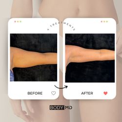 BodyMD - In just 4 sessions, check out this jaw-
dropping arm makeover with EMSculpt NEO!