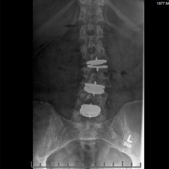 Rasouli Spine - My new spine! - Spine Surgeons Near Me - Beverly Hills, California Rasouli Spine - My new spine! - Spine Surgeons Near Me - Beverly Hills, California