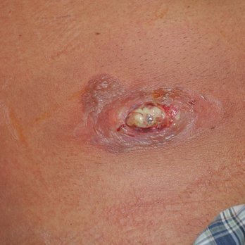 Australian Tan - This is that infection that i mentioned in my negative review against this dirty, and unprofessional place, that nearly caused my death. - Spray Tanning Near Me - Sunnyvale, California Australian Tan - This is that infection that i mentioned in my negative review against this dirty, and unprofessional place, that nearly caused my death. - Spray Tanning Near Me - Sunnyvale, California