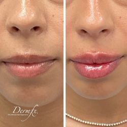DermFx