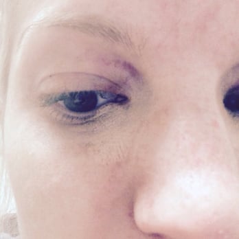 Lotus Nails & Spa - This is what happens if you get your eye brows waxed there.... A big bruise. DO NOT come to this salon! - Nail Salons Near Me - Schertz, Texas Lotus Nails & Spa - This is what happens if you get your eye brows waxed there.... A big bruise. DO NOT come to this salon! - Nail Salons Near Me - Schertz, Texas
