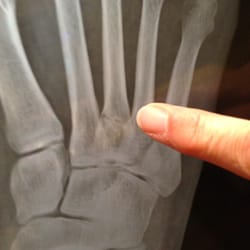 Ellis F Pizzi, DPM - Mom pointing to my broken foot