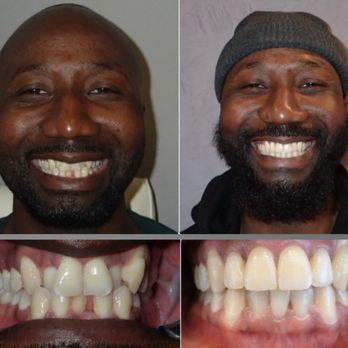 Smile Solutions Orthodontists - invisalignmississauga-beforeandafter - Orthodontists Near Me - Brampton, Ontario Smile Solutions Orthodontists - invisalignmississauga-beforeandafter - Orthodontists Near Me - Brampton, Ontario