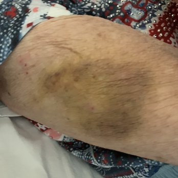Seasons Belleair Memory Care - Bruises that couldn't be explained even after telling administration. - Assisted Living Facilities Near Me - Clearwater, Florida Seasons Belleair Memory Care - Bruises that couldn't be explained even after telling administration. - Assisted Living Facilities Near Me - Clearwater, Florida