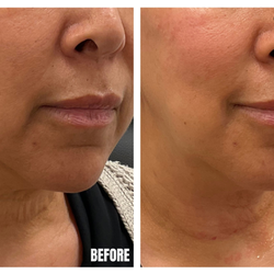SORAH Aesthetics - Neck rejuvenation treatment to soften lines, improve crepey skin, and restore a more youthful appearance.