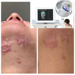 Limitless Skincare & Beauty - RF microneedling