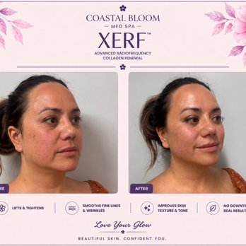 Coastal Bloom Med Spa - Xerf radiofrequency collagen renewal immediate results - Medical Spas Near Me - San Diego, California Coastal Bloom Med Spa - Xerf radiofrequency collagen renewal immediate results - Medical Spas Near Me - San Diego, California