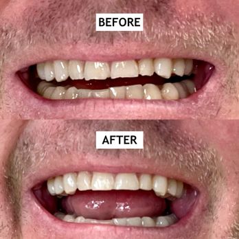 Steven M Sanchez, DDS - Enameloplasty - Top four teeth - General Dentistry Near Me - Boerne, Texas Steven M Sanchez, DDS - Enameloplasty - Top four teeth - General Dentistry Near Me - Boerne, Texas