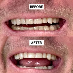 Steven M Sanchez, DDS - Enameloplasty - Top four teeth