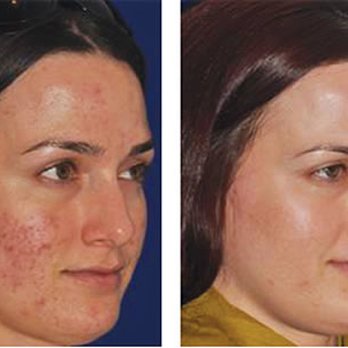 Radiant Med Spa - Microneedling - Laser Hair Removal Near Me - Fremont, California Radiant Med Spa - Microneedling - Laser Hair Removal Near Me - Fremont, California