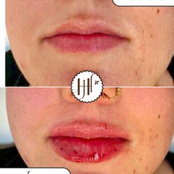 Honey Hued Medi Spa - Mini dose, mega confidence. 1/2 syringe = full glam.
