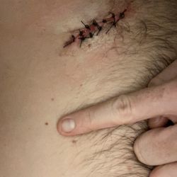 Randy Jacobs Dermatology - Stitches after the operation.